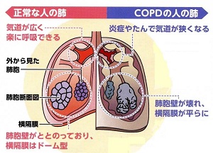 肺の比較