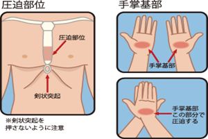 圧迫部位